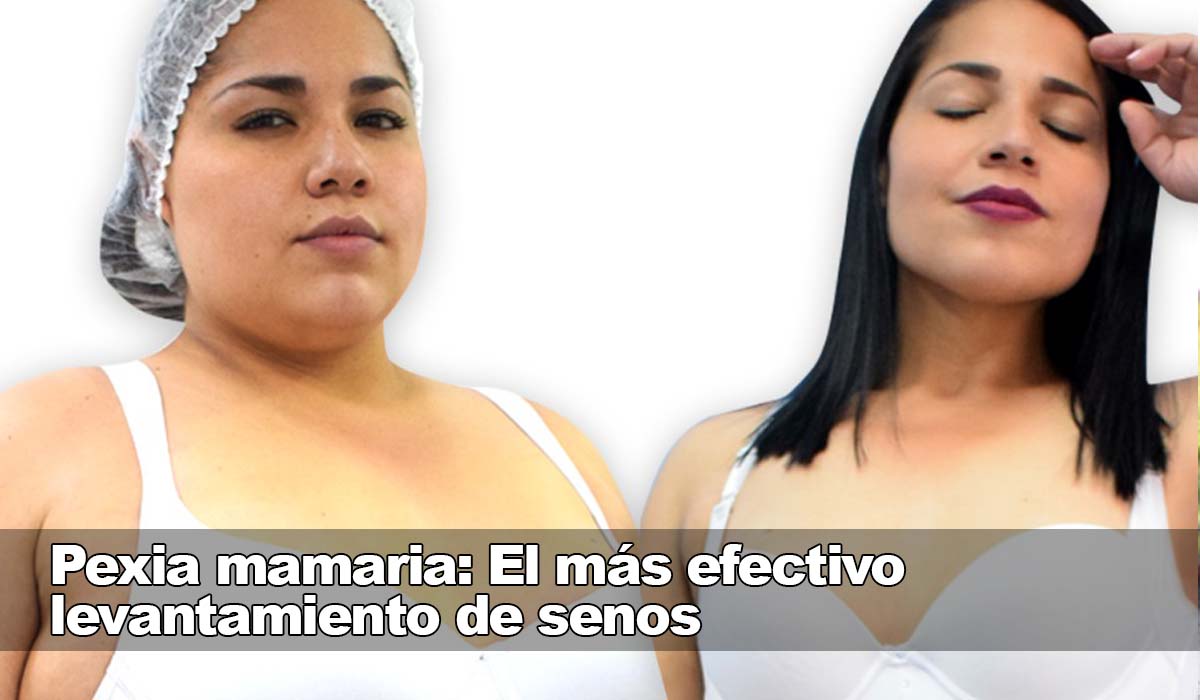 Dr Cubillos pexia mamaria levantamiento de senos